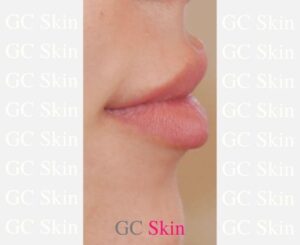 GC Skin Medspa Fillers Lip Before