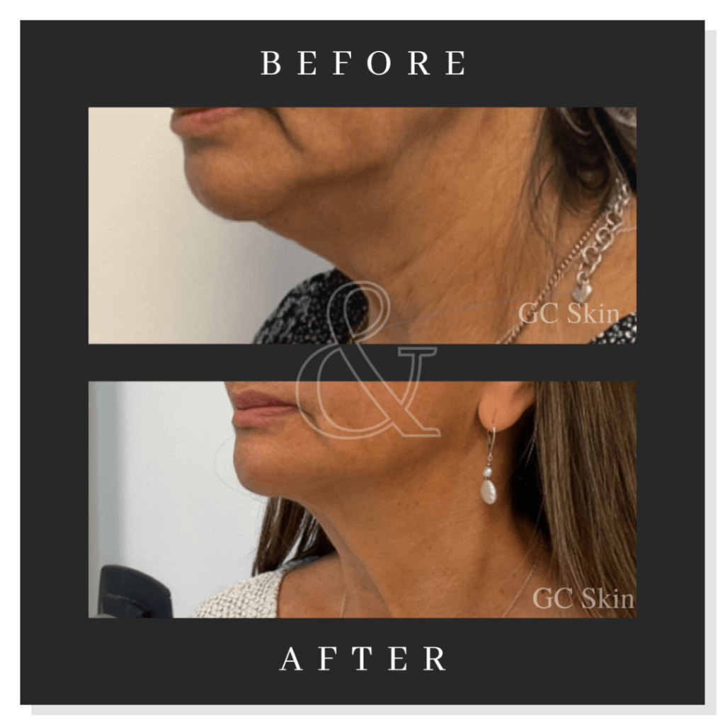 Accutite before and After Photos Case 1