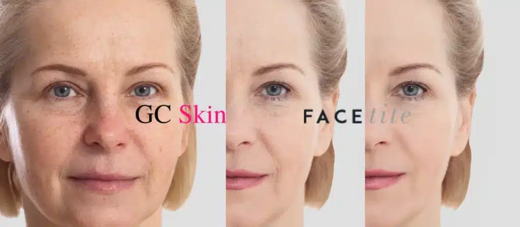 the advantages of facetite over traditional facelift