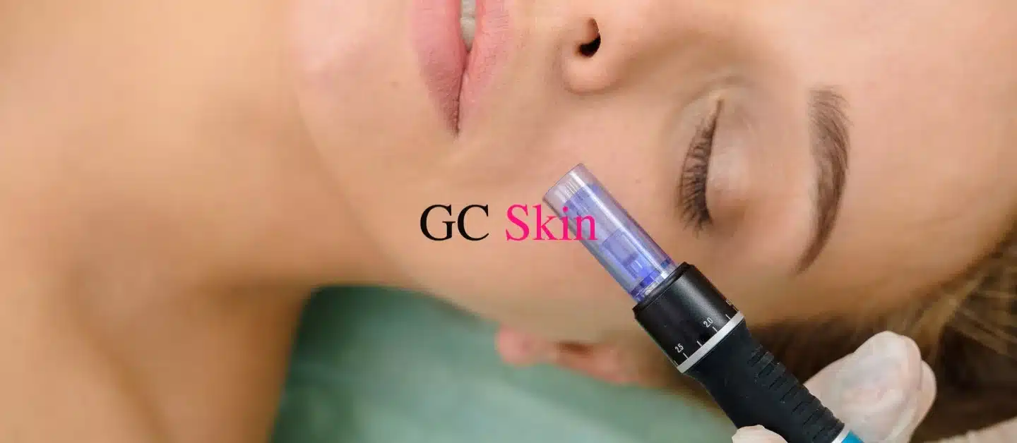 What are the benefits of microneedling?